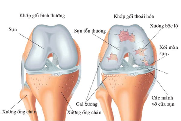 /uploads/1563939593-nhung-con-dau-do-thoai-hoa-khop-khien-nguoi-benh-kho-co-the-chiu-noi.jpg