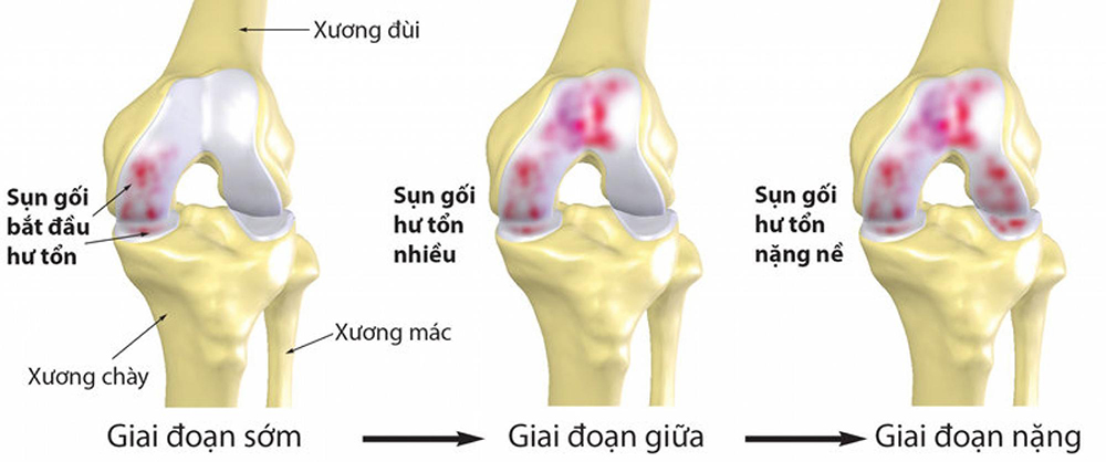 /uploads/1563972434-giai-doan-thoai-hoa-khop.jpg