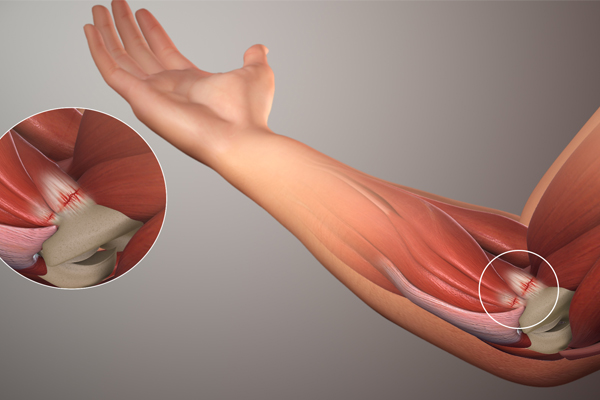 /uploads/1563977335-dieu-tri-hoi-chung-tennis-elbow.jpg