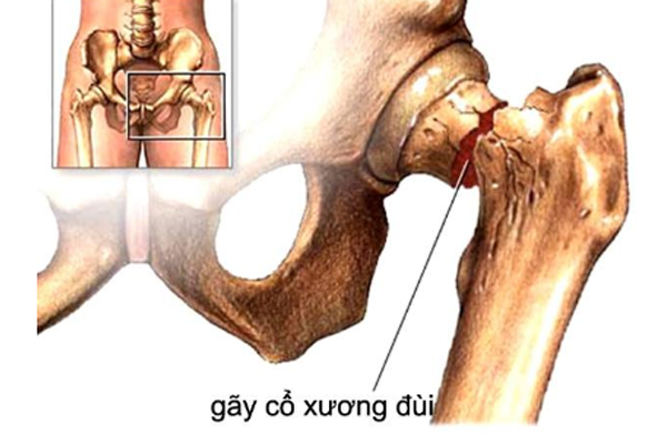 /uploads/1566742413-gay-co-xuong-dui-01.png