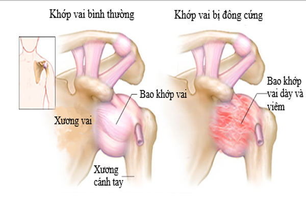 /uploads/1566743144-viem-khop-vai-the-dong-dac-01.png
