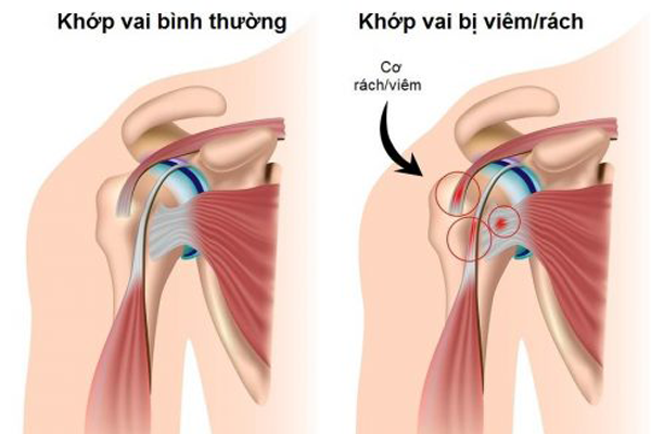 /uploads/1566744177-tiep-can-1-benh-nhan-dau-vai-02.jpg