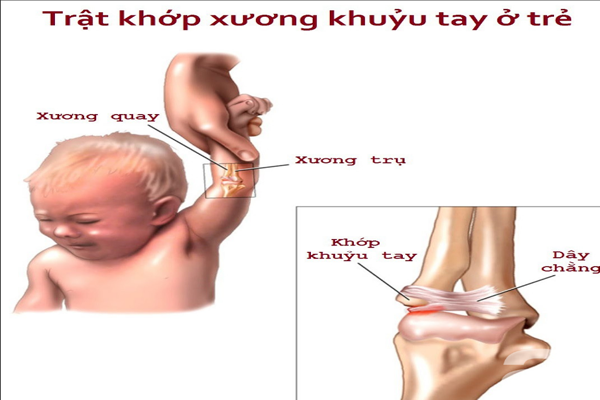 /uploads/1567606142-trat-khuyu-tay-01.png