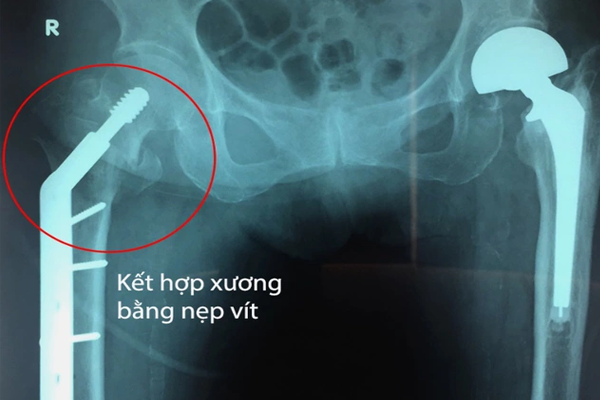 /uploads/1568984319-gay-mau-chuyen-xuong-dui-03.png