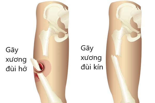 /uploads/1571323547-gay-xuong-dui-01.png