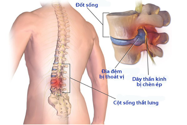 /uploads/1571325395-thoat-vi-dia-dem-lung-01.png