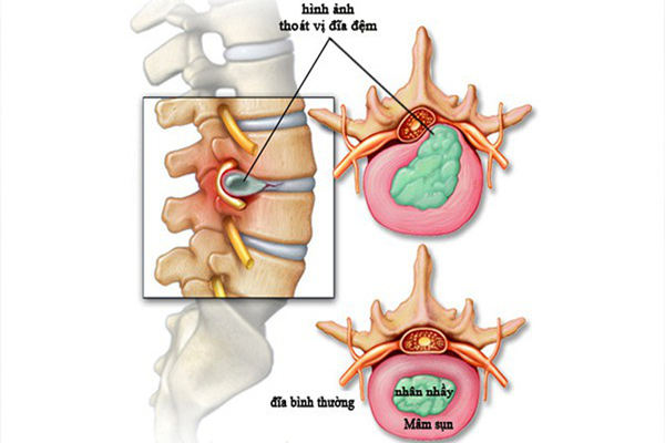/uploads/1579272316-dieu-tri-thoat-vi-dia-dem-khong-phau-thuat-01.png