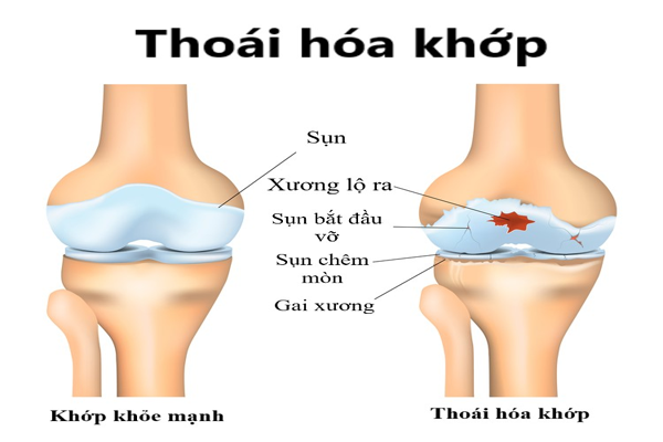 /uploads/1579272999-benh-co-xuong-khop-01.png
