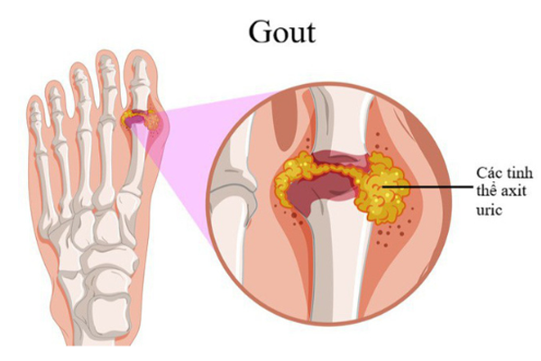 /uploads/1580483677-benh-gout-01.png