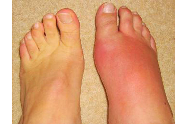 /uploads/1580483678-benh-gout-02.png