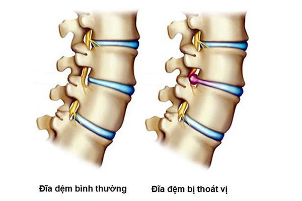 /uploads/1580484231-phuong-phap-khac-phuc-thoat-vi-dia-dem-01.png