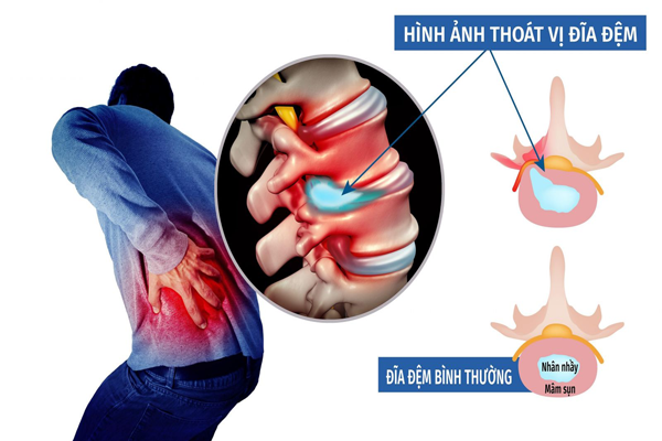 /uploads/1580484232-phuong-phap-khac-phuc-thoat-vi-dia-dem-02.png