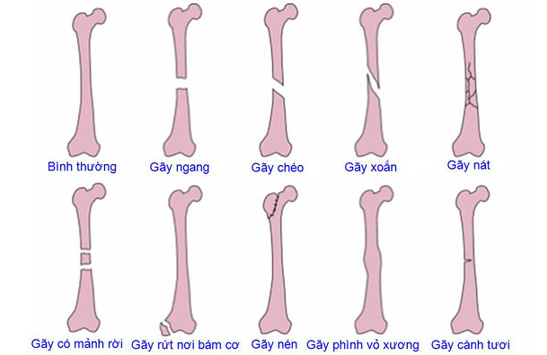 /uploads/1597248039-bo-thuoc-gia-truyen-dieu-tri-gay-xuong-01.jpg