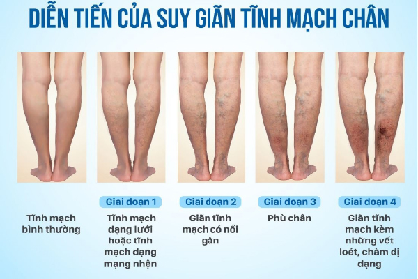 /uploads/1742196505-cac-cap-do-gian-tinh-mach.jpg