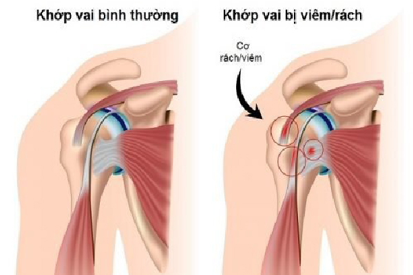 /uploads/1743213400-viem-co-nhi-dau-khop-vai.jpg