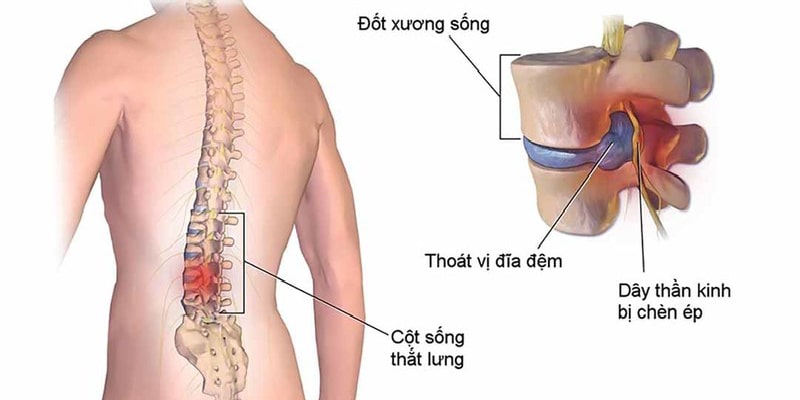 /uploads/1743581060-dau-that-lung-hong-xuat-phat-tu-nhieu-benh-ly.jpg